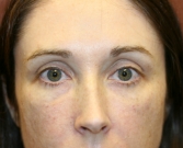 Feel Beautiful - Filler for darkness of lower eyelids - After Photo